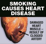 Australia 2012 Health Effects Heart - diseased organ front