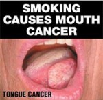 Australia 2012 Health Effects Mouth - tongue cancer, gross front