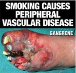 Australia 2012 Health Effects Vascular - gangrene gross front