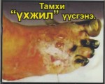 Mongolia 2014 Health Effects vascular system - gangrene
