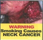 Suriname 2014 - Health Effects other - neck cancer (front)