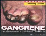 Suriname 2014 Health Effects vascular system - gangrene (back)