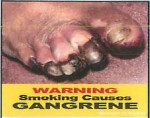 Suriname 2014 Health Effects vascular system - gangrene (front)