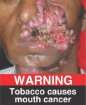 India 2015 Health Effects Mouth - mouth cancer, gross face