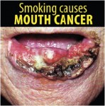 Philippines 2014 Health Effects Mouth - mouth cancer, gross (English)