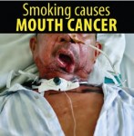 Philippines 2014 Health Effects Mouth - mouth cancer, lived experience (English)