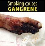 Philippines 2014 Health Effects Vascular System - gangrene, gross (English)