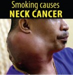 Philippines 2014 Health Effects other - neck cancer, lived experience (English)