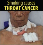 Philippines 2014 Health Effects other - throat cancer, lived experience (English)