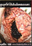 Thailand 2014 Health Effects heart - diseased organ, gross
