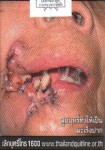 Thailand 2014 Health Effects mouth - mouth cancer, gross