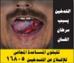 Egypt 2012 Health Effects Mouth - tongue cancer, lived experience, gross