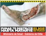 Chile 2012 Health Effects Vascular System - gangrene, gross