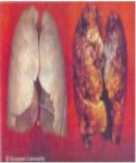 2013 Fiji Health Effect lung - lung cancer, diseased lung