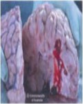 2013 Fiji Health Effect stroke - brain, risk