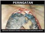 2014 Indonesia Health Effects lung - diseased organ, gross
