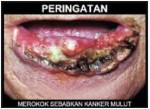 2014 Indonesia Health Effects mouth - gross, lip