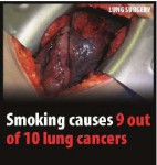 EU 2016 Health Effects lung - lung cancer, surgery