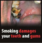 EU 2016 Health Effects mouth - tooth and gum damage