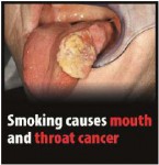 EU 2016-Set 2-Health Effects mouth - mouth and throat cancer, gross