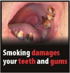 EU 2016-Set 2-Health Effects mouth - tooth and gum damage
