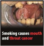 EU 2016-Set 3-Health Effects mouth - tongue, gum, cancer, gross