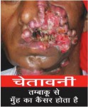 India 2016 Health Effects Mouth - mouth cancer, gross face_hindi