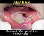 Malaysia 2014 Health Effects Mouth - mouth cancer, gross (front)