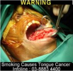 Malaysia 2014 Health Effects Mouth - tongue cancer, gross , surgery (back)