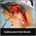 Mauritius 2009 Health Effects Heart - open heart surgery - Eng