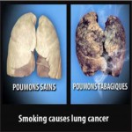 Mauritius 2009 Health Effects Lung - healthy vs unhealthy comparison, lung cancer, EN