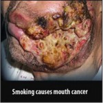 Mauritius 2009 Health Effects Mouth - mouth cancer, gross_EN