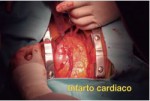 Mexico 2011 Health Effects heart - infarction, open heart surgery