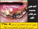 Egypt 2014 Health Effects Mouth - lip cancer, gross