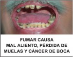 Panama 2009 Health Effects Mouth - mouth cancer, tooth loss, bad breath
