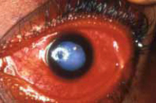Aussie 2002 Health Effects eye - diseased organ, eye disease 2, gross