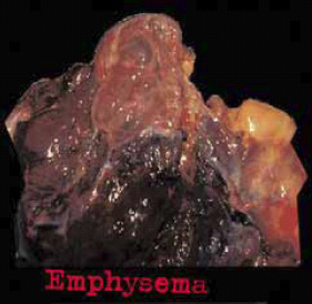 Aussie 2002 Health Effects lung - diseased organ, emphysema, gross