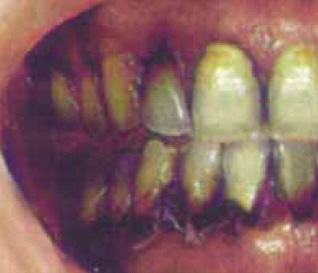 Aussie 2002 Health Effects mouth - diseased organ, mouth & gum disease, gross