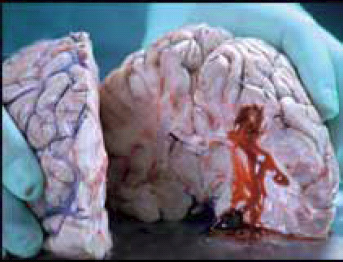 Aussie 2002 Health Effects stroke - diseased organ, brain, stroke, gross