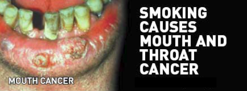 Aussie 2006 Health Effects mouth PACK - diseased organ, mouth & throat cancer, gross